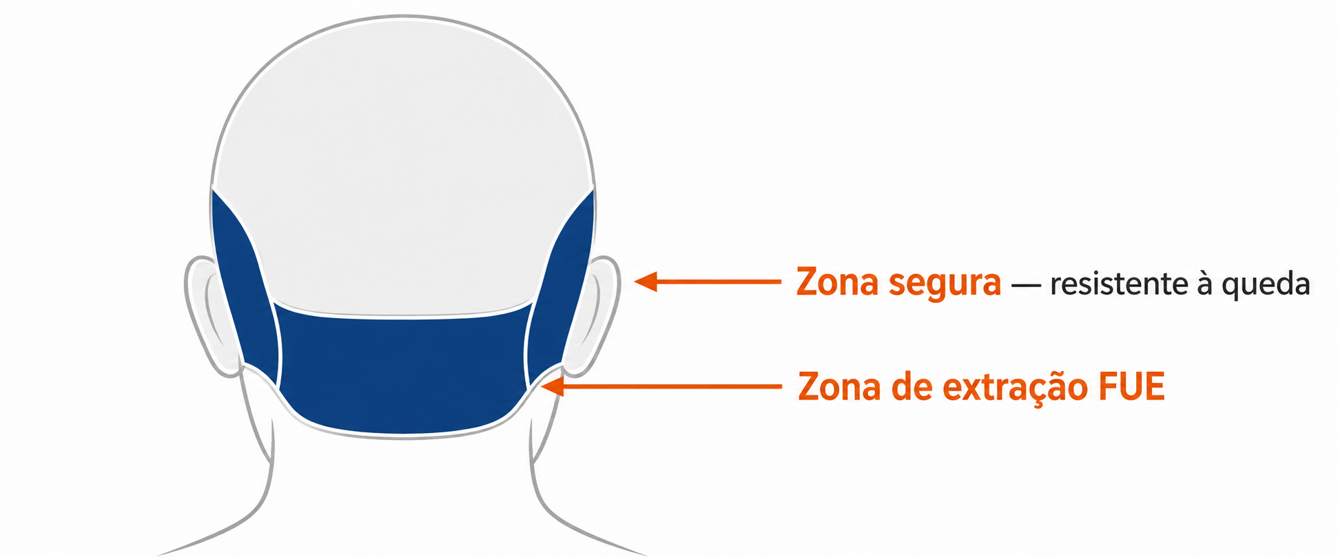 Infográfico mostrando a localização da área doadora no transplante capilar FUE e as regiões de extração de folículos