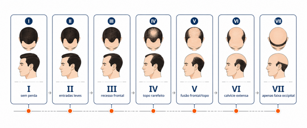 Infográfico da Escala de Norwood mostrando os 7 graus de alopecia androgenética masculina