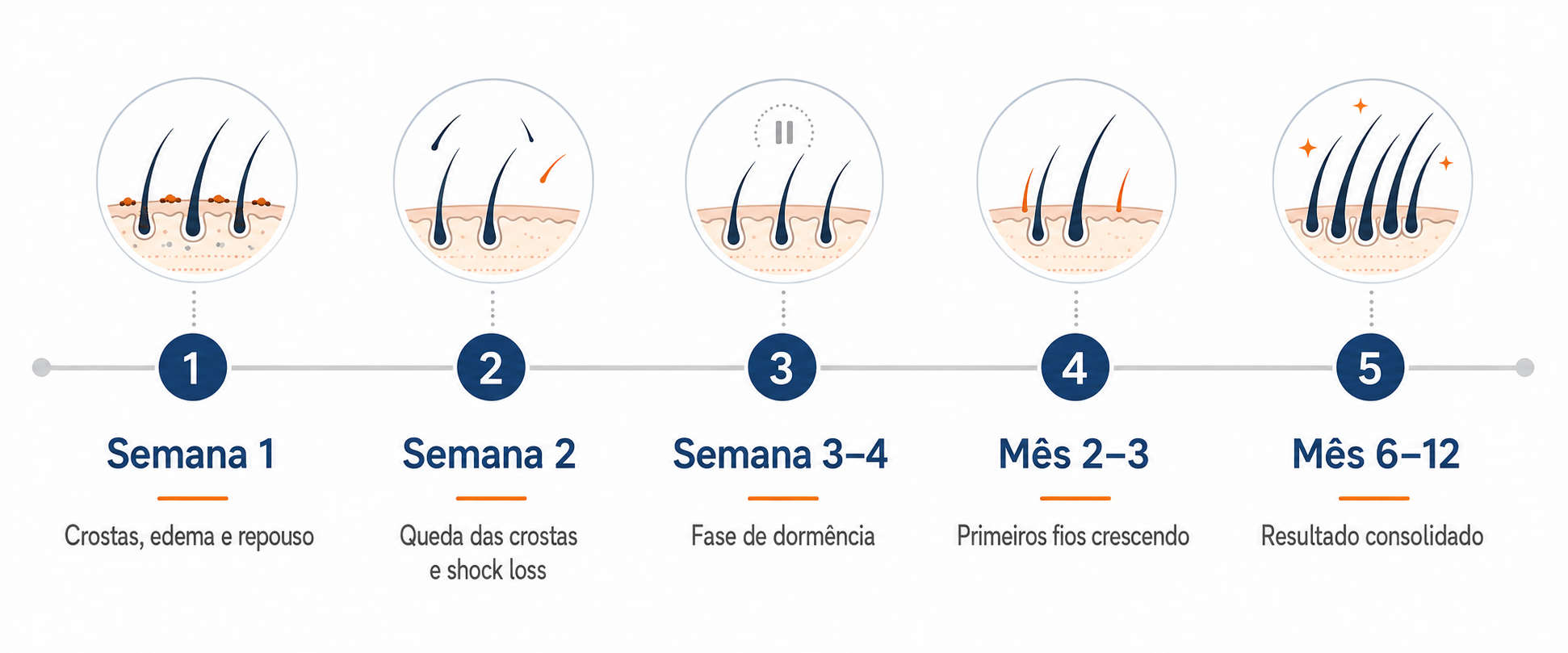 Infográfico do pós-operatório do transplante capilar semana a semana: da Semana 1 ao Mês 3, o que acontece com os fios