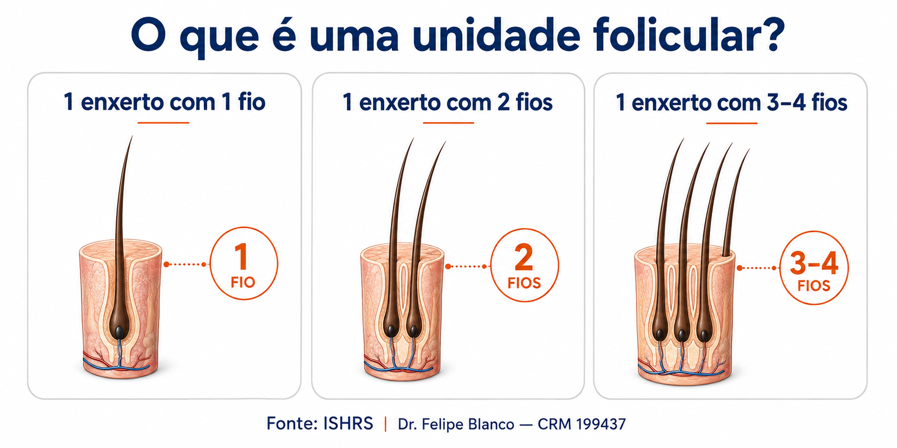 Infográfico explicando a diferença entre fios e enxertos no transplante capilar