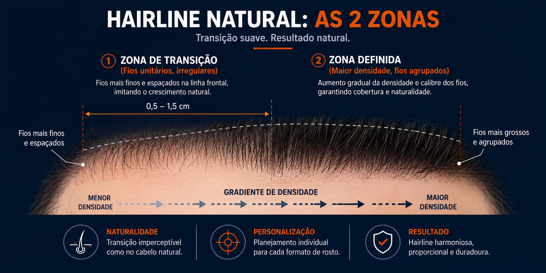Diferença entre zona de transição com fios unitários e zona definida com maior densidade no transplante capilar
