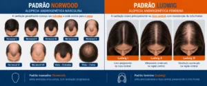 Comparativo visual entre o padrão de calvície masculina (entradas e coroa) e feminina (rarefação difusa na risca central)