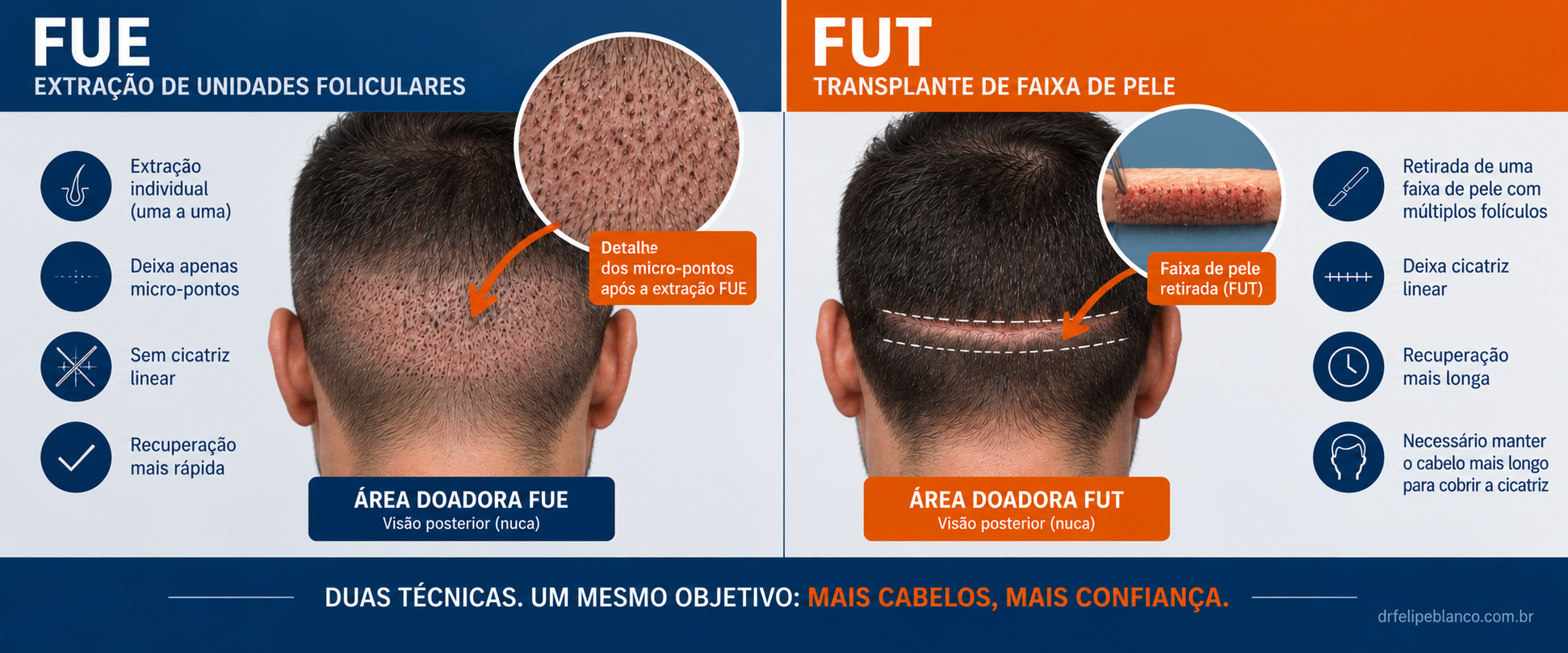 Diagrama mostrando a diferença na extração da área doadora entre FUE (folículo a folículo) e FUT (faixa linear de pele)