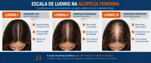 Infográfico da Escala de Ludwig mostrando os três graus de calvície feminina com rarefação progressiva na linha central